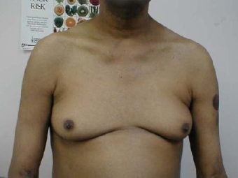 Гинекомастия. Изображение с сайта www.living-with-large-breasts.com