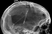 Рентгенограмма головы больного с электродами. Фото Cleveland Clinic