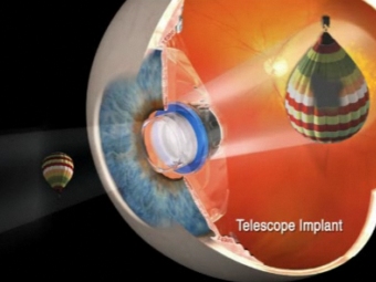 Принцип работы телескопа. Кадр презентации VisionCare