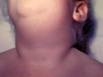Увеличенные слюнные железы у больного свинкой. Фото CDC