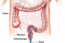 Колоноскопия, иллюстрация с сайта kycoloncancersite.com