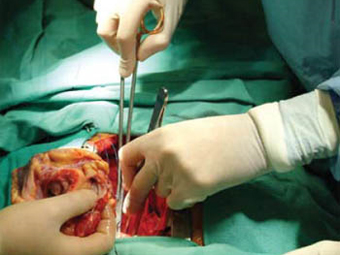 Пересадка сердца. Фото с сайта clevelandclinic.org