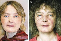 Изабель Динуар после операции - с косметикой и без нее. Фото New England Journal of Medicine.