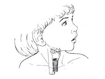 Изображение с сайта tracheostomy.com