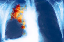 Рак легких, иллюстрация с сайта sciencephoto.com
