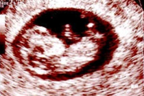 Эмбрион в утробе матери, восьмая неделя беременности, фото УЗИ с сайта cincinnatifertility.com 