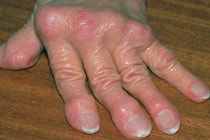 Ревматоидный артрит. Фото с сайта www.4-arthritis-info.com