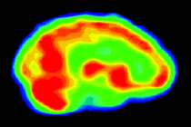 позитронно-эмиссионная томография головного мозга, фото с сайта physics.utoronto.ca