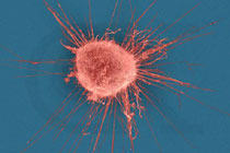 Клетка раковой опухоли молочной железы. Фото с сайта http://www.alternative-cancer.net