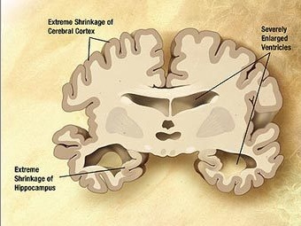 Мозг пациента с болезнью Альцгеймера, фото с сайта wikipedia.org