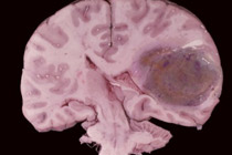 Глиобластома. Изображение с сайта www.sciencephoto.com