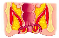Парапроктит. Рисунок с сайта http://medical-dictionary.thefreedictionary.com