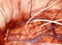 Иллюстрация neurosurgery.umc.edu