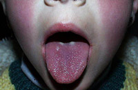 Скарлатина, фото с сайта www.clinical-virology.org