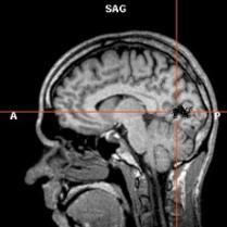 Иллюстрация с сайта Neurologie.uni-duesseldorf.de