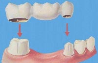 Фиксированные зубные протезы. Рисунок с сайта www.teethluver.com