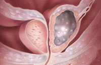 Причины рака предстательной железы (простаты). Рисунок с сайта www.sciencephoto.com