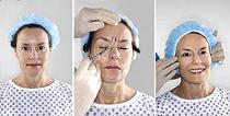 Лечение «Ботоксом». Фото с сайта http://creative.gettyimages.com