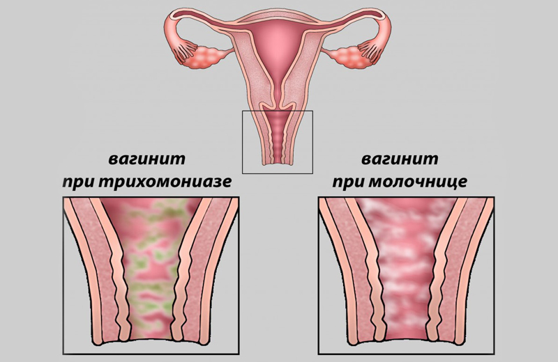 Вагинит, симптомы и лечение вагинита