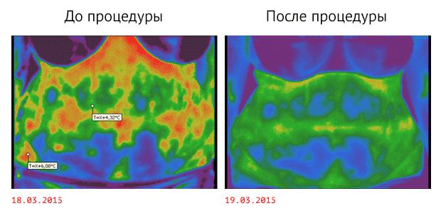 Уменьшение и прекращение воспалительных процессов, улучшение периферического кровообращения / Термографические снимки С.М. Козловского