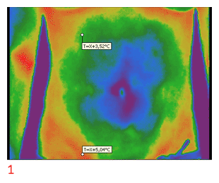 Исчезновение «холодной зоны» вокруг пупка / Термографические снимки С.М. Козловского