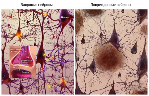 При болезни Альцгеймера связи между нейронами разрываются © National Institute on Aging