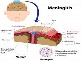 менингит