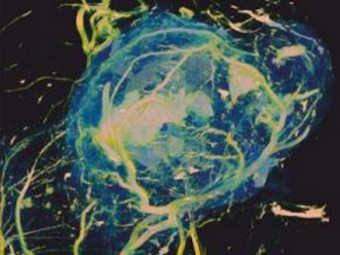 Флуоресцентное изображение раковой опухоли с активным метаболизмом глюкозы (голубой). Фото авторов