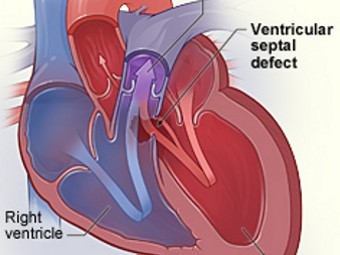 Врожденный дефект межжелудочковой перегородки. Иллюстрация с сайта nhlbi.nih.gov