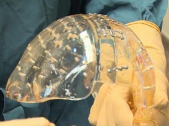 Пластиковый биоимплантат черепной коробки, напечатанный на 3D-принтере. Скриншот видео авторов 