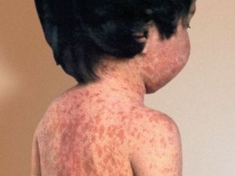 Состояние кожи во время болезни корью. Изображение с сайта med39.ru