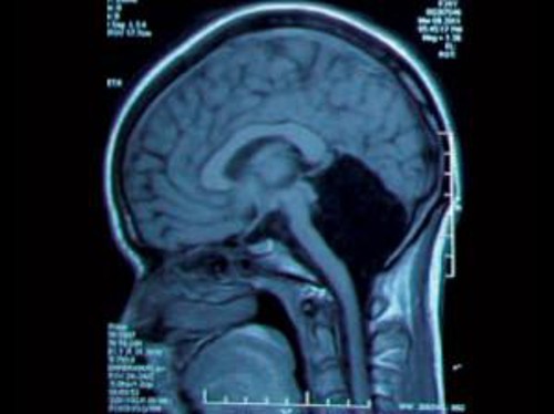 Результаты сканирования головного мозга пациентки. На месте, где должен быть мозжечок, видна "черная дыра"