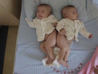 3D-печать помогла разделить сиамских близнецов