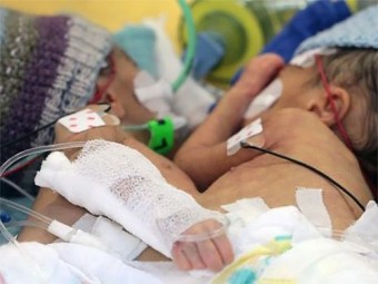В Швейцарии успешно разделили восьмидневных сиамских близнецов-девочек