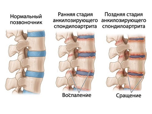Вальгус у взрослых лечение