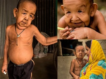 Мальчик из Бангладеш в четыре года выглядит восьмидесятилетним
