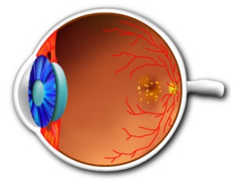 Дистрофия сетчатки глаза. Изображение с сайта vitreoretinalcenter.com