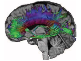 Диффузионная тензорная визуализация мозга. Изображение с сайта bodyhealthguides.com