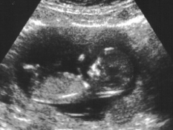 УЗИ при беременности. Изображение с сайта pregnancy-stage.com