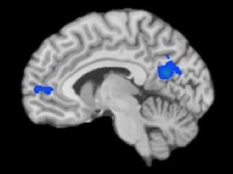 Нейронная сеть ненаправленной активности на фМРТ. Изображение авторов исследования