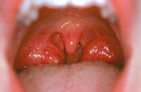 Шум В Ушах И Циннаризин