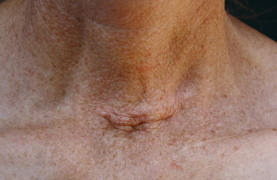 Лечение дифференцированного рака щитовидной железы thumbnail